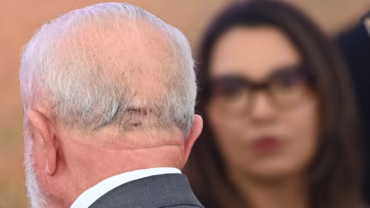 Lula vai passar por novo procedimento médico para impedir sangramentos no cérebro